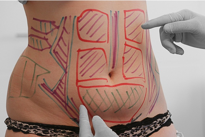 Mommy-Makeover bei Dr Altintas Weiterer Text über ots und www.presseportal.de/nr/143391 / Die Verwendung dieses Bildes ist für redaktionelle Zwecke honorarfrei. Veröffentlichung bitte unter Quellenangabe: